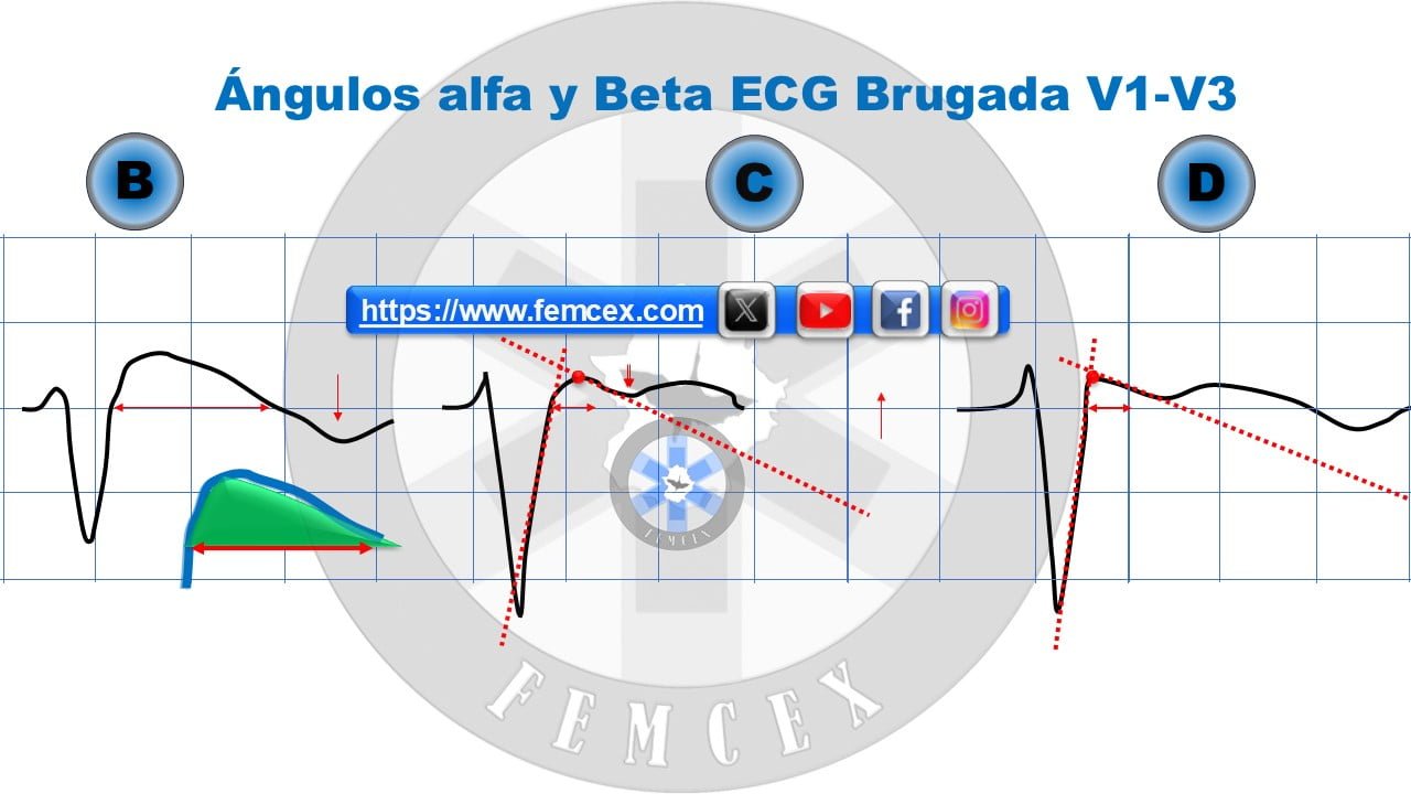 ngulo-beta-electrocardiogr-fico-femcex