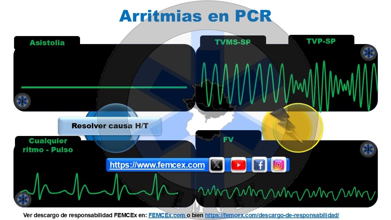 Arritmias de PCR